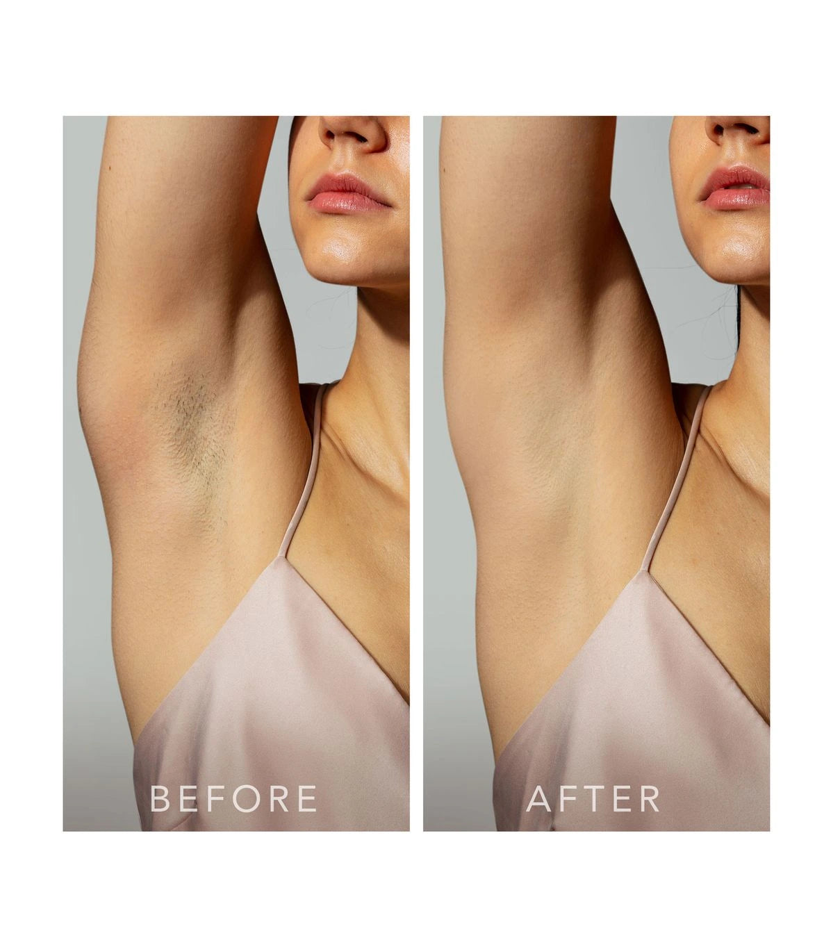 ¡Dile Adiós al Pánico de la Depilación! Despigmenta tu Zona Íntima y Olvídate de los Vellos Encarnados.